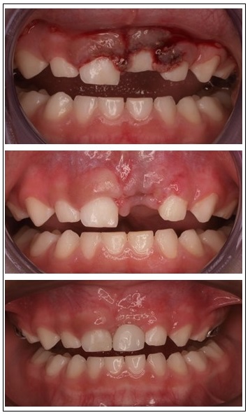Traumatisme dental infantil