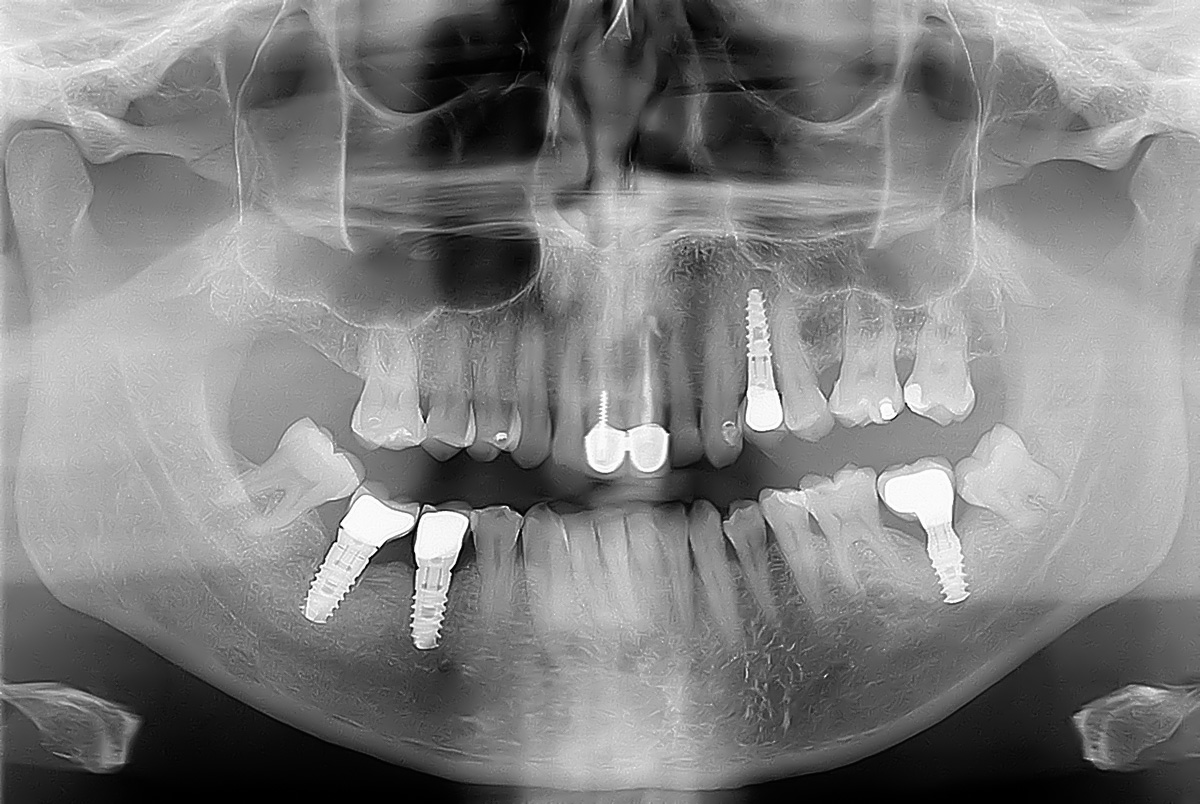 Periimplantitis una amenaca pel teu implant dental