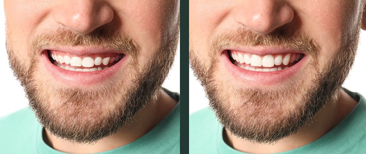 Somriure gingival: ensenyes molta geniva quan somrius?