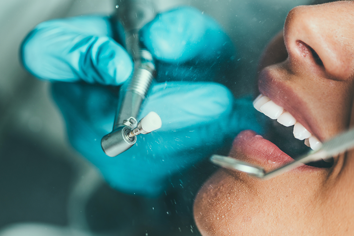 La higiene dental professional mites i veritats de la profilaxis