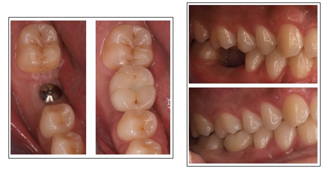 Implant unitari