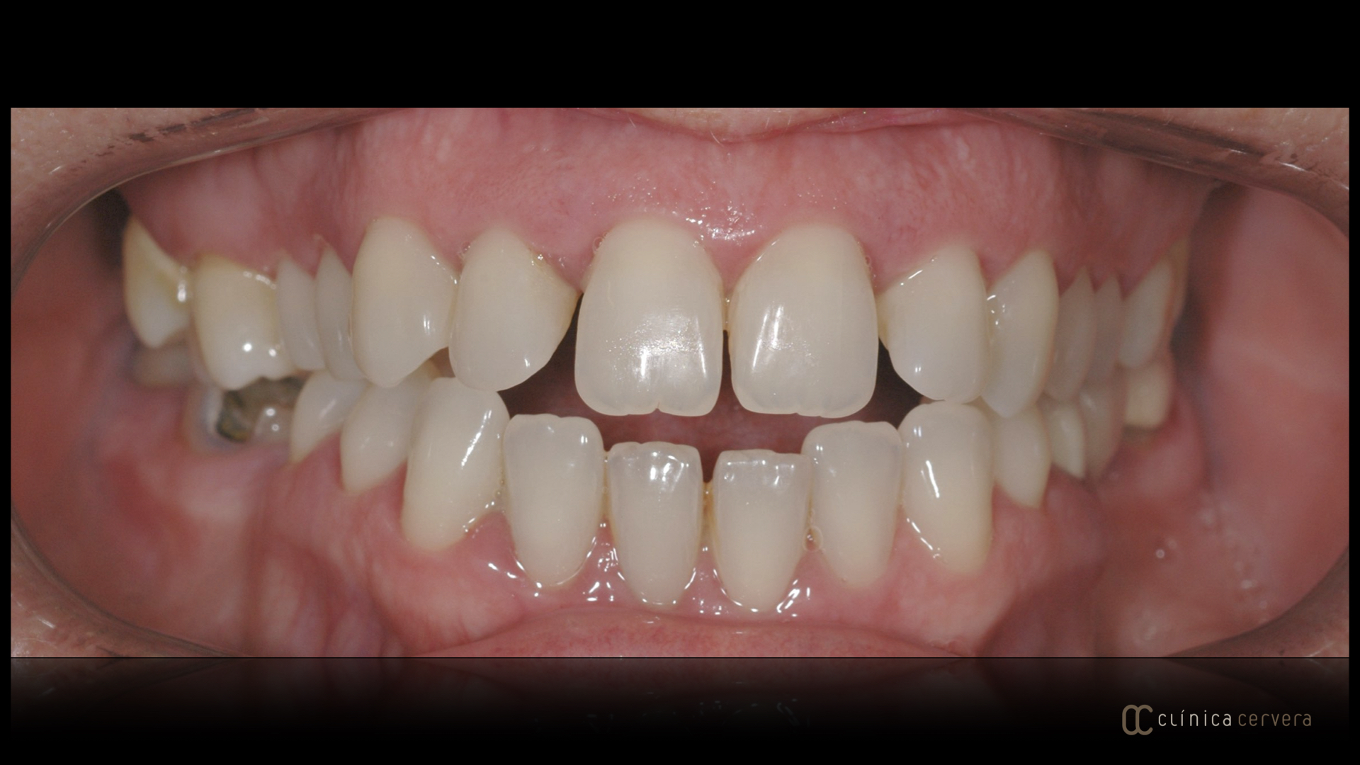 Malaltia periodontal