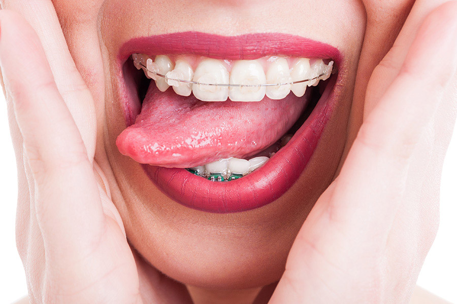 Ortodòncia per adults brackets als 50