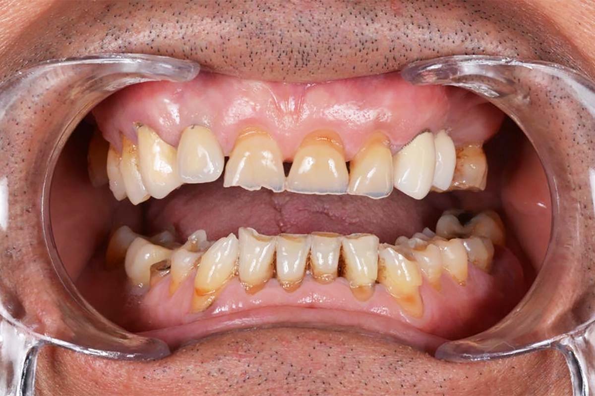 Bruxisme serres o prems les dents entre si sense ser conscient