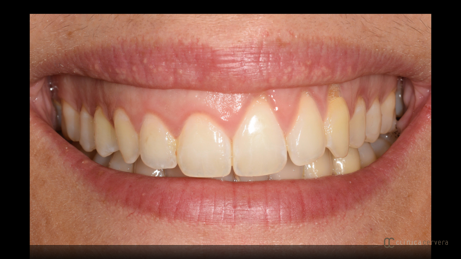 Assimetria gingival
