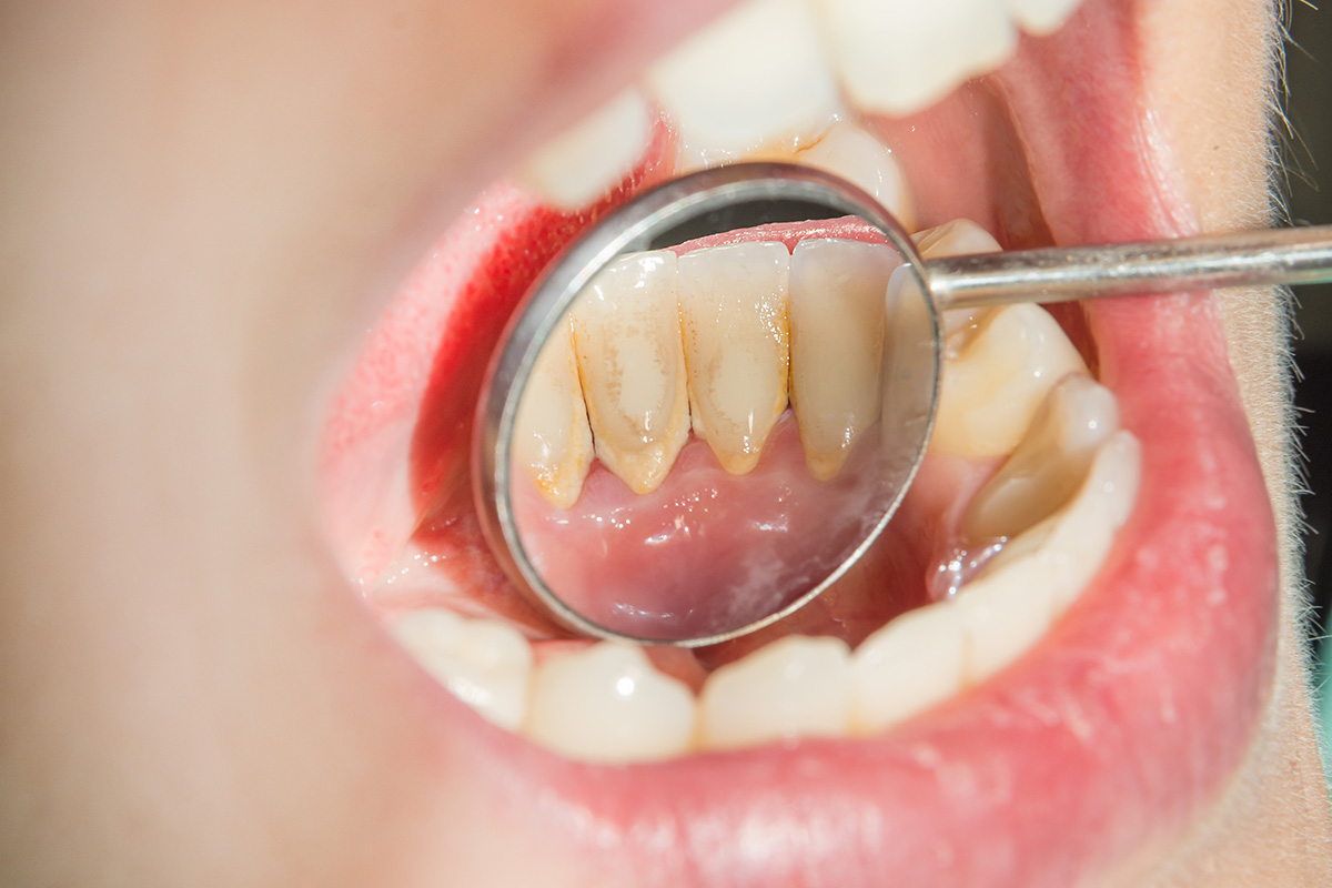 Quin és el millor remei casola per eliminar el calcul de les dents