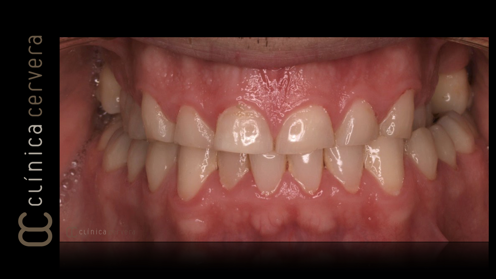 Desgastos dentals