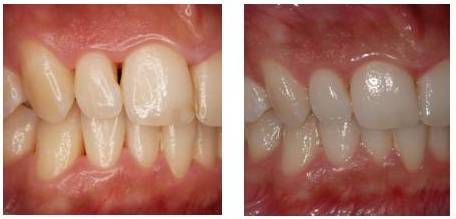 Estimulador gingival