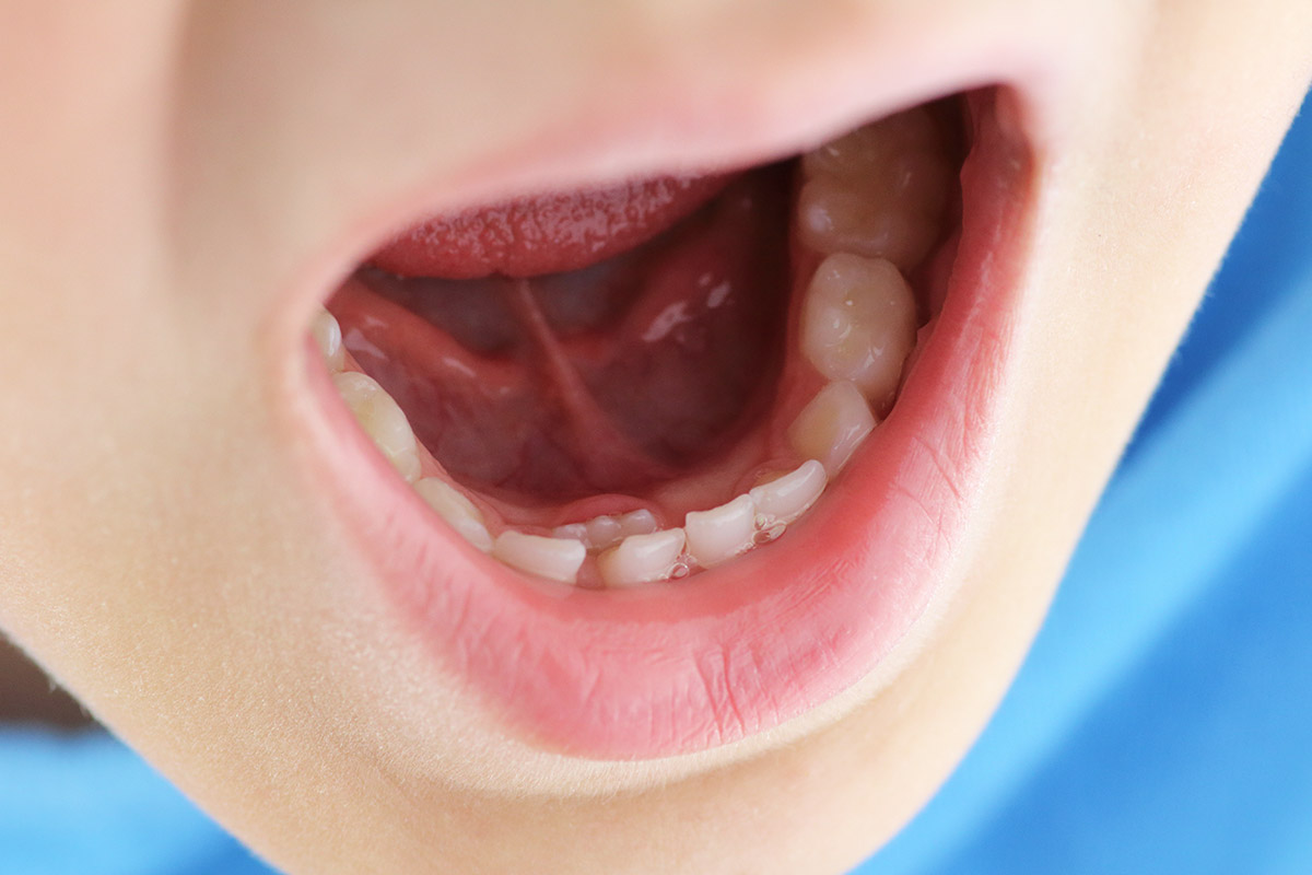 Dents de tauro per que al meu fill li ha sortit una doble fila de dents