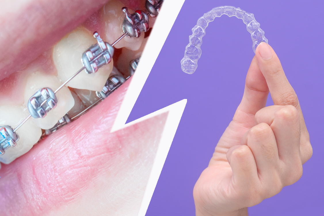 Braquets vs ortodòncia invisible