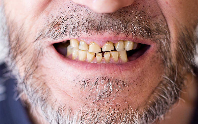 Com evitar el desgast dental