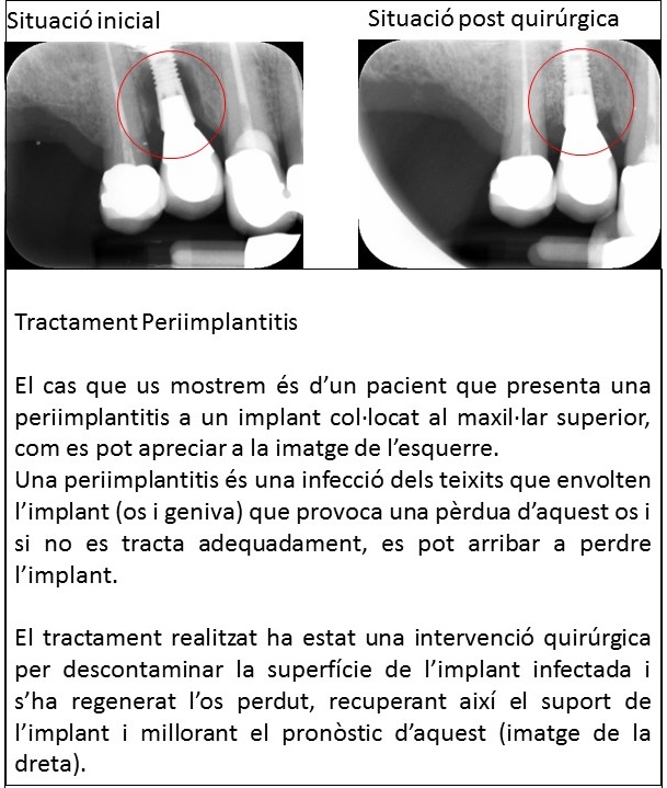 Tractament Periimplantitis