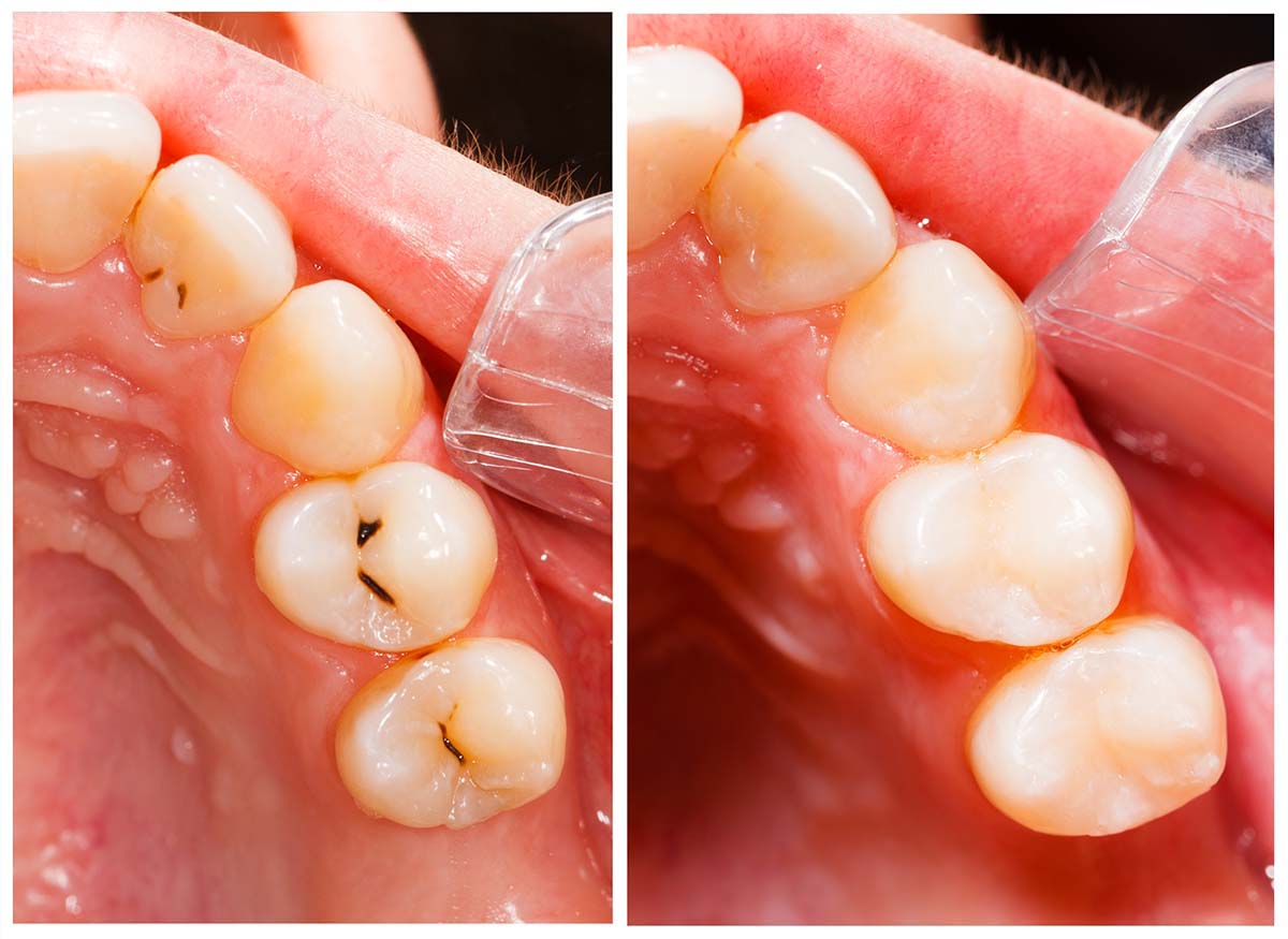 En que consisteixen les obturacions dentals