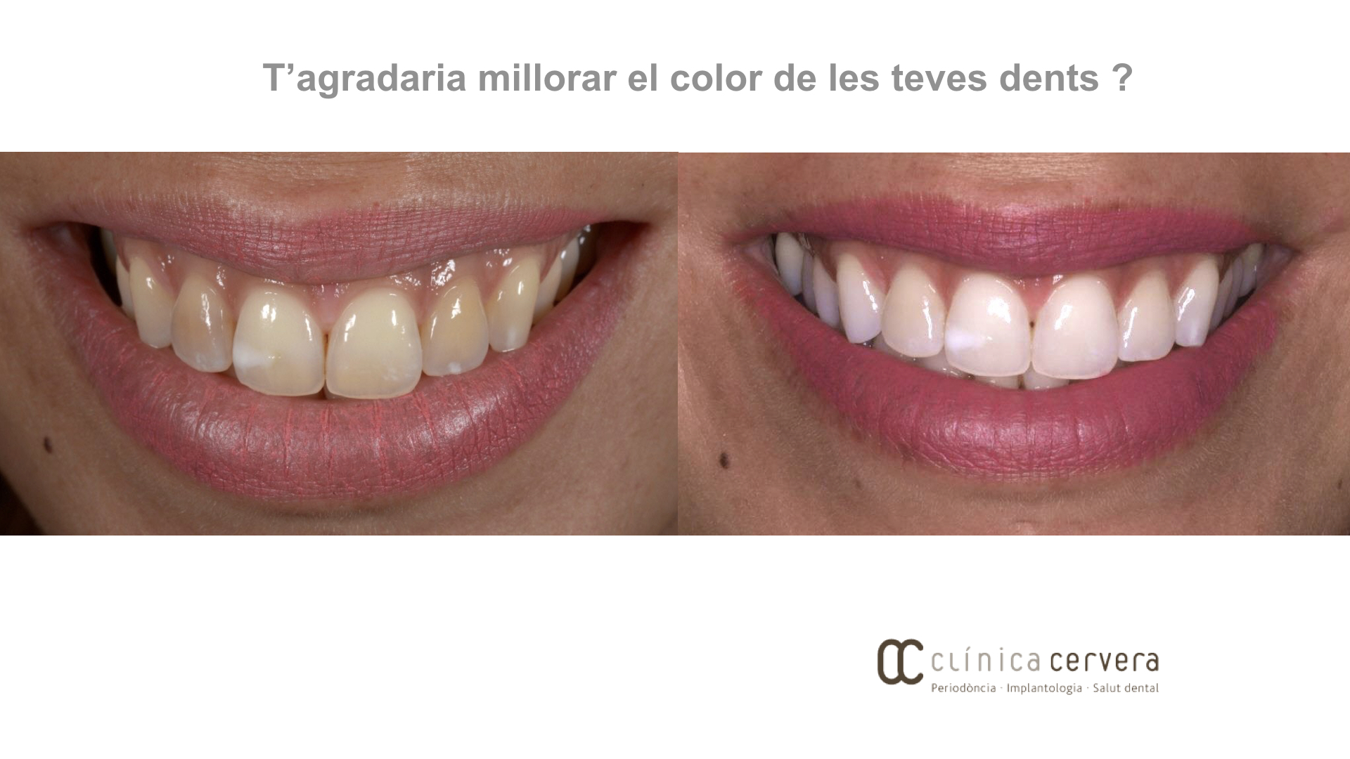 Emblanquiment dental