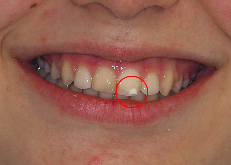 Taques blanques a les dents: per què surten?