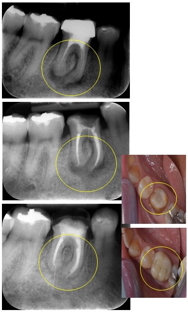 Reendodòncia a primer molar inferior dret