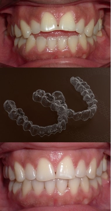 Tractament de la malposició dental amb alineadors transparents (Invisalign)
