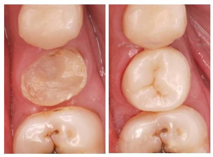 Reconstrucció d’un premolar inferior endodonciat amb una incrustació de composite.