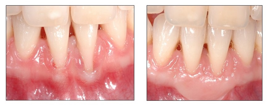 Empelt Gingival