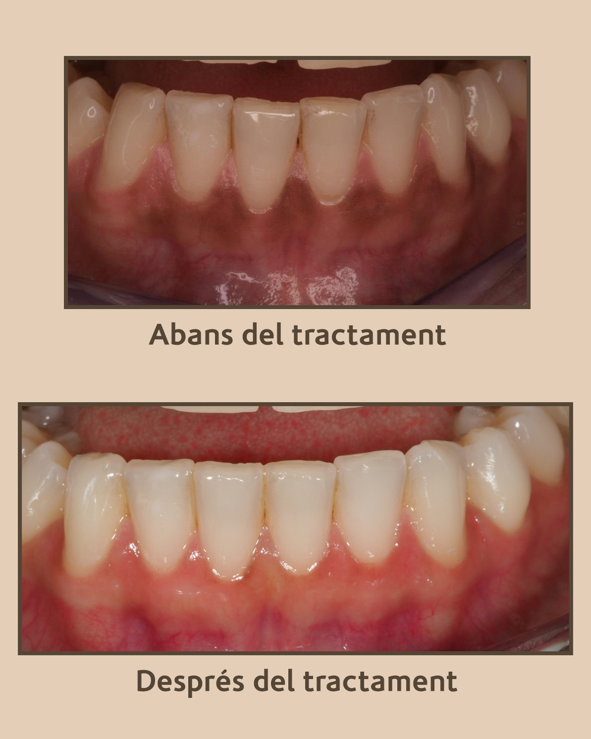 Melanosi gingival que és aquesta taca a la geniva