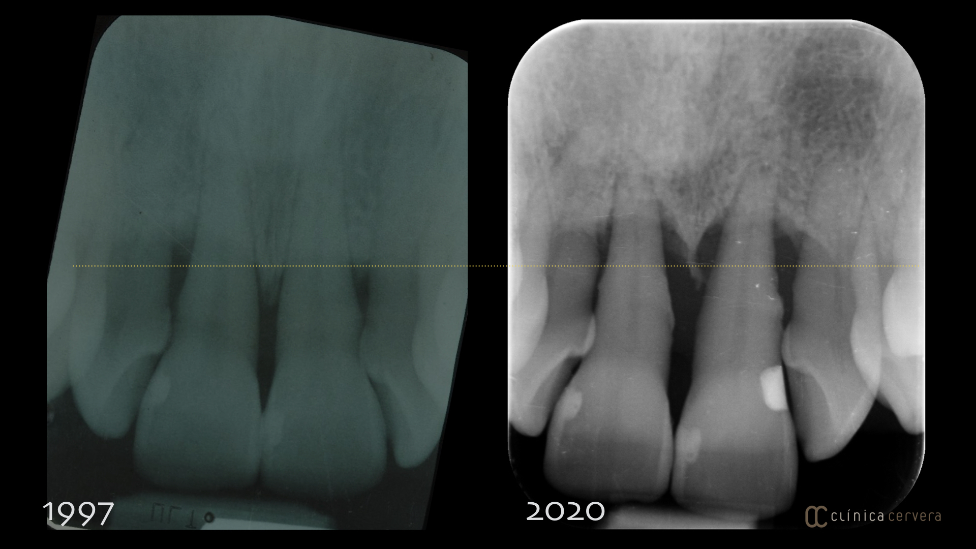 Manteniment periodontal