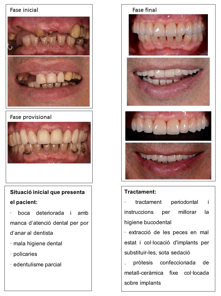 Tractament rehabilitador amb implants i pròtesis dental