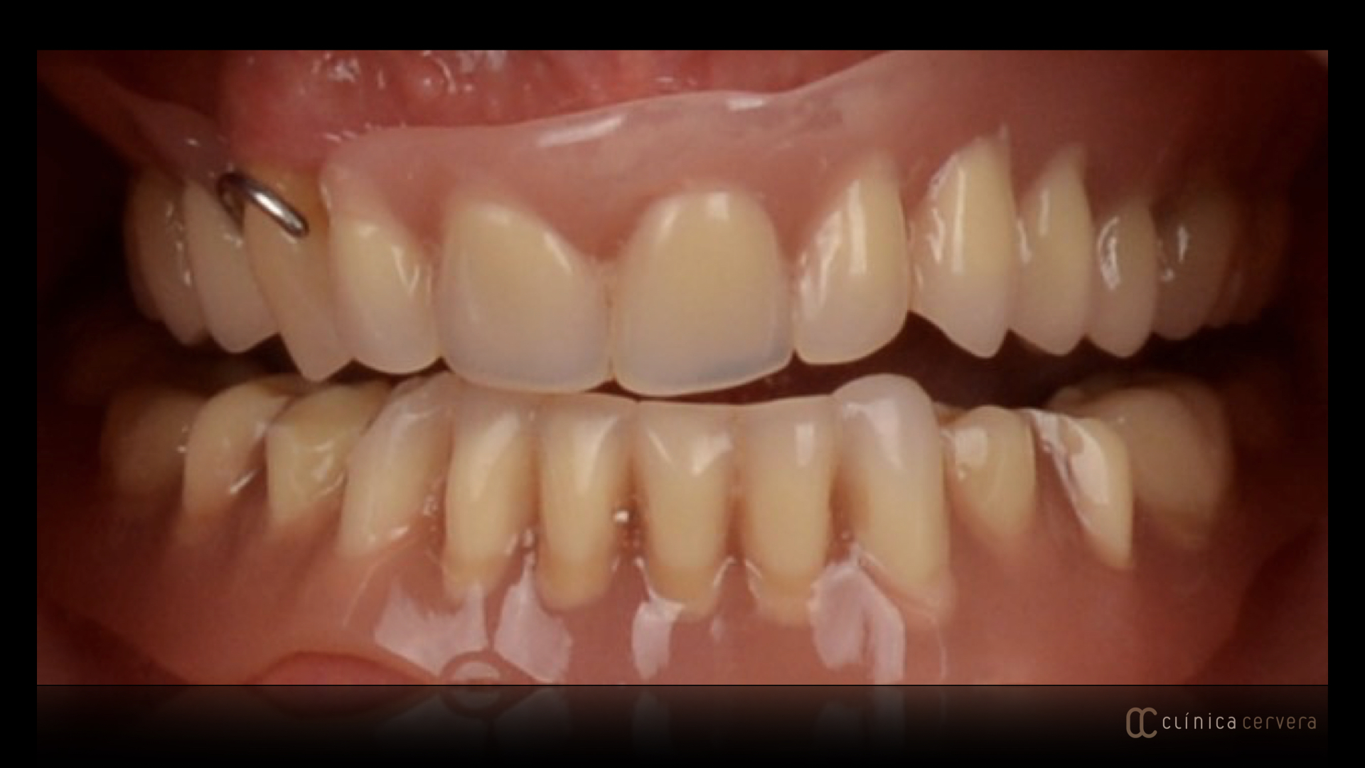 Sobredentadures