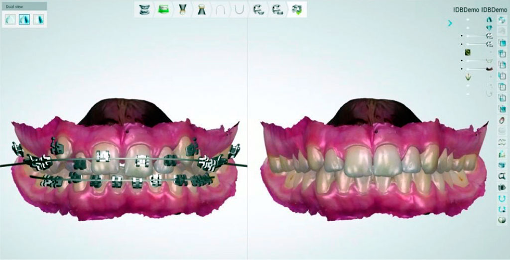 Clínica Cervera incorpora l escaner intraoral per agilitzar els tractaments