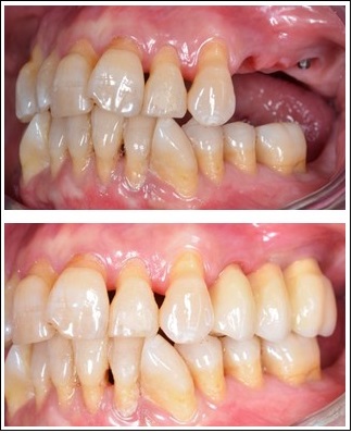 Rehabilitació amb corones sobre implants a pacients periodontals