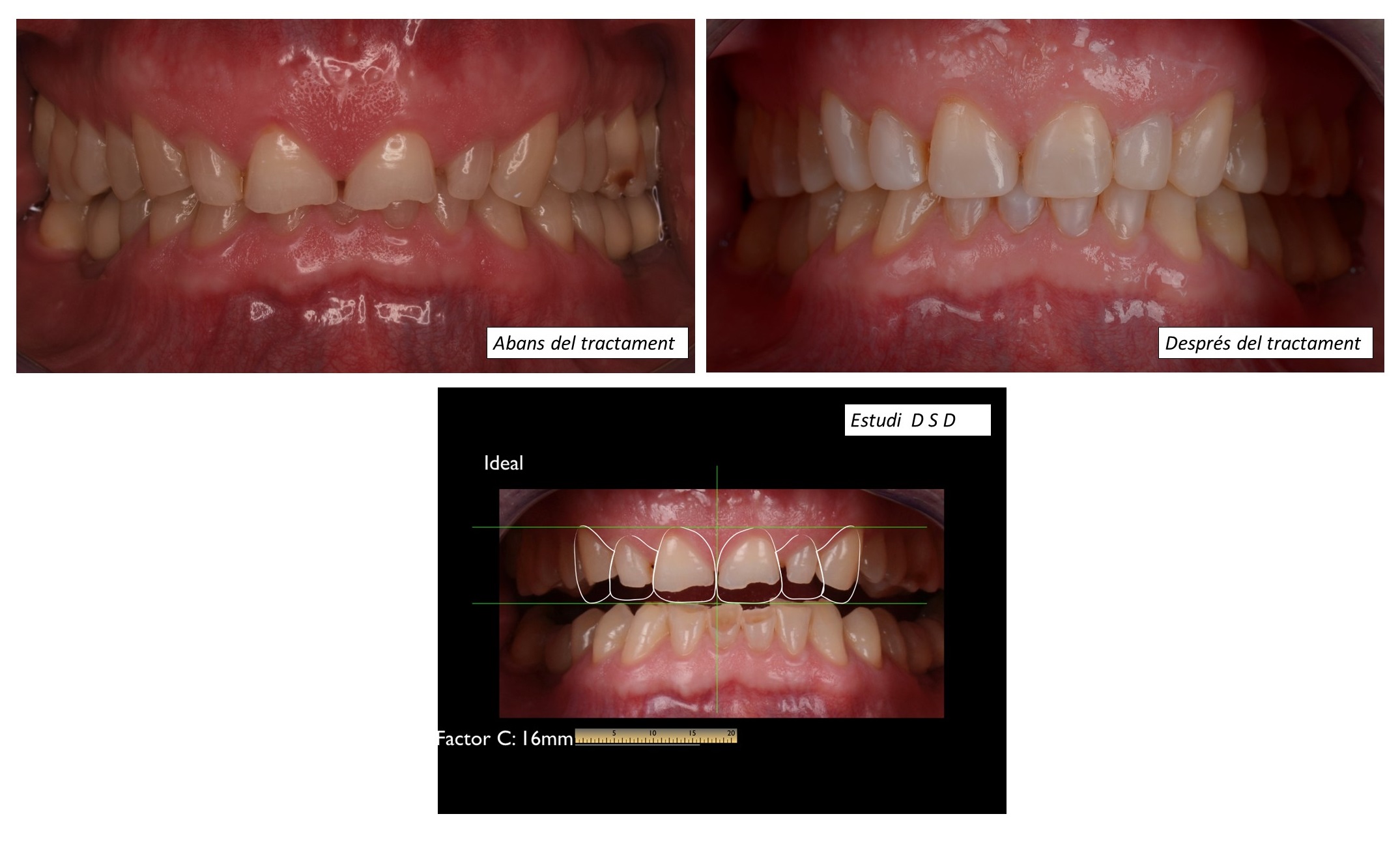 Tractament amb tècnica DSD (Disseny Digital del Somriure)