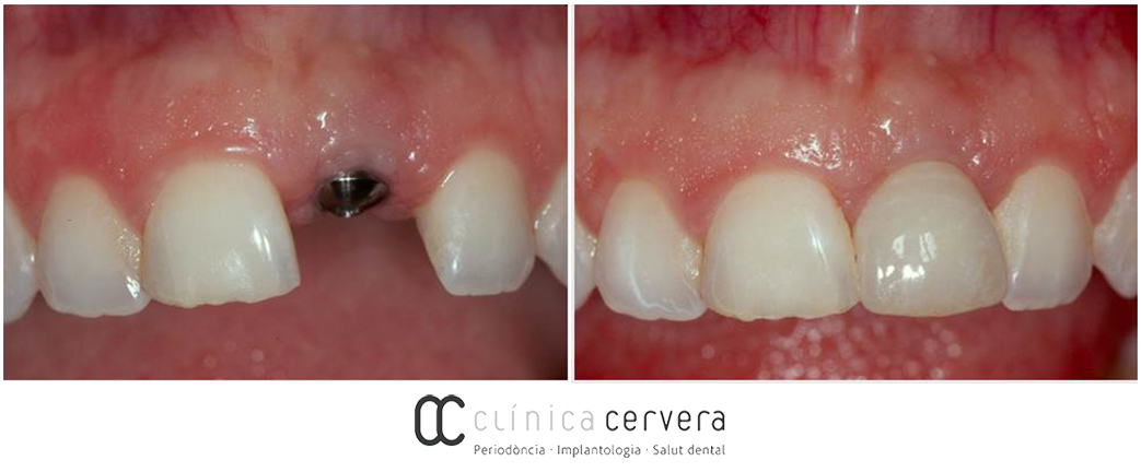 Implants dentals els dubtes més comuns