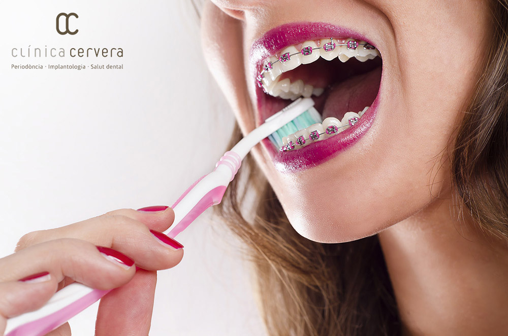 Consells d higiene bucodental per persones amb ortodòncia fixa