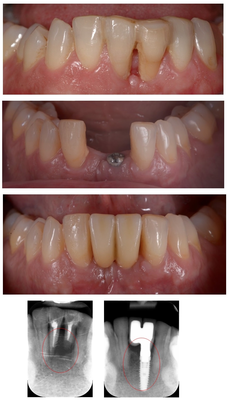 Rehabilitació amb implant dental inferior