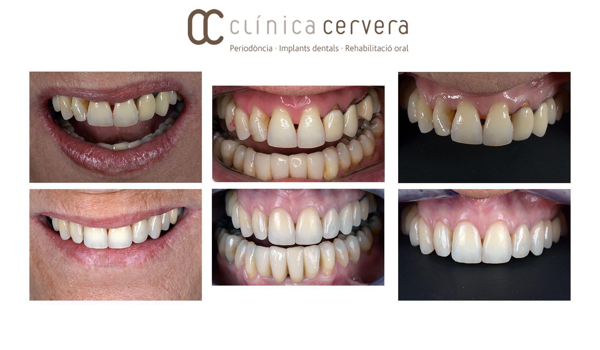 Troneres per que apareixen triangles negres entre les dents i com eliminar los