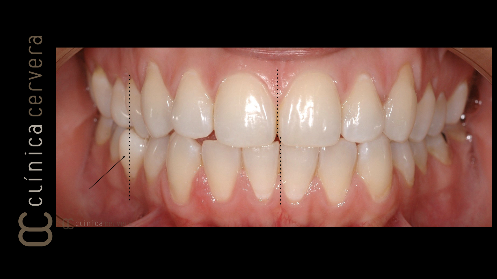 Ortodòncia amb Invisalign