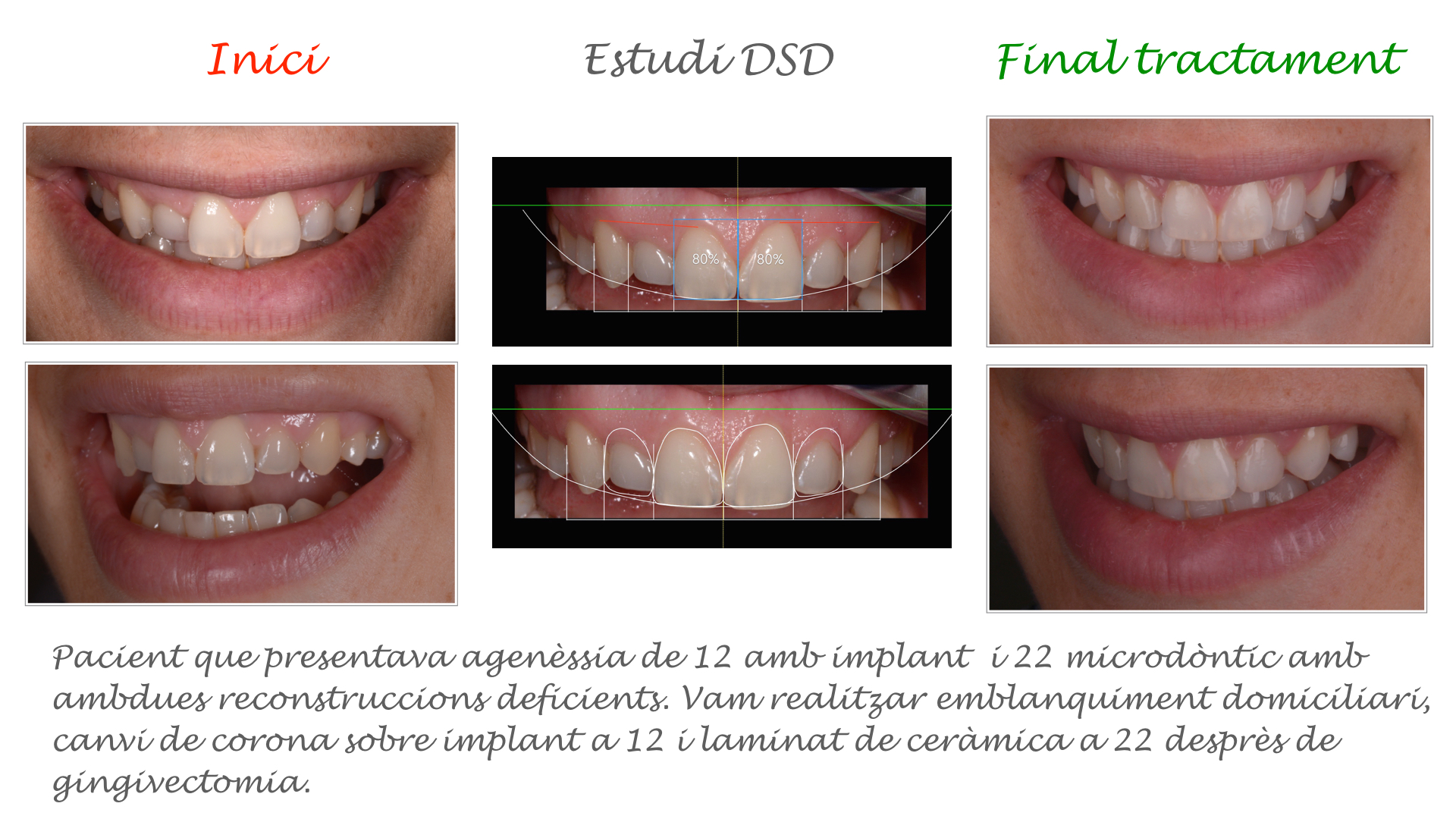 Tècnica DSD (Disseny digital del Somriure)
