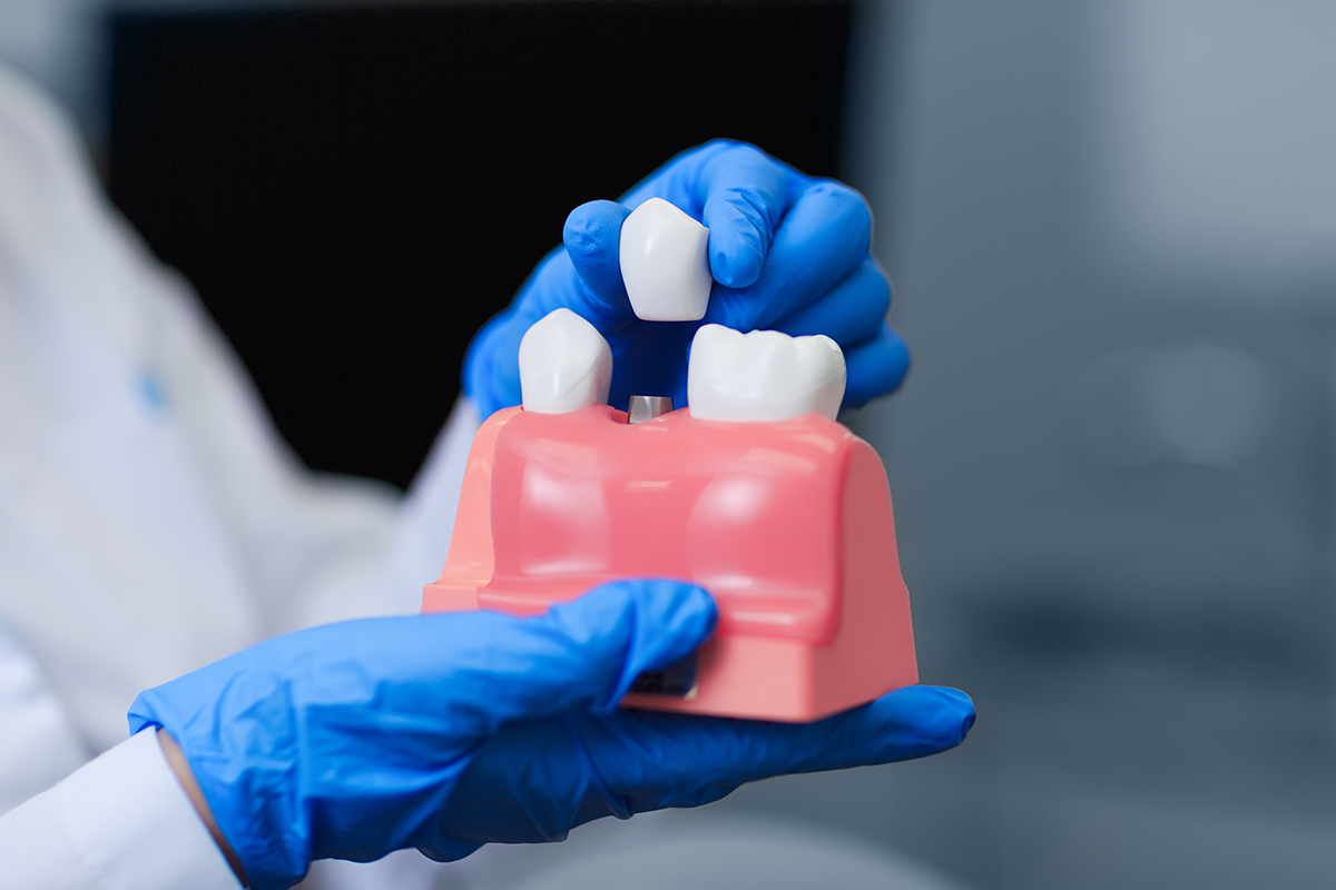 Implants ponts o dentadura postissa quina és la millor protesi dental