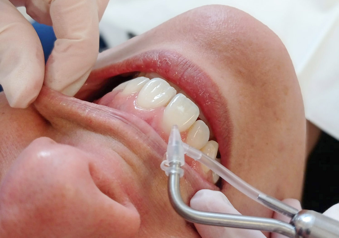 Aquacare l odontologia sense contacte arriba a Clínica Cervera