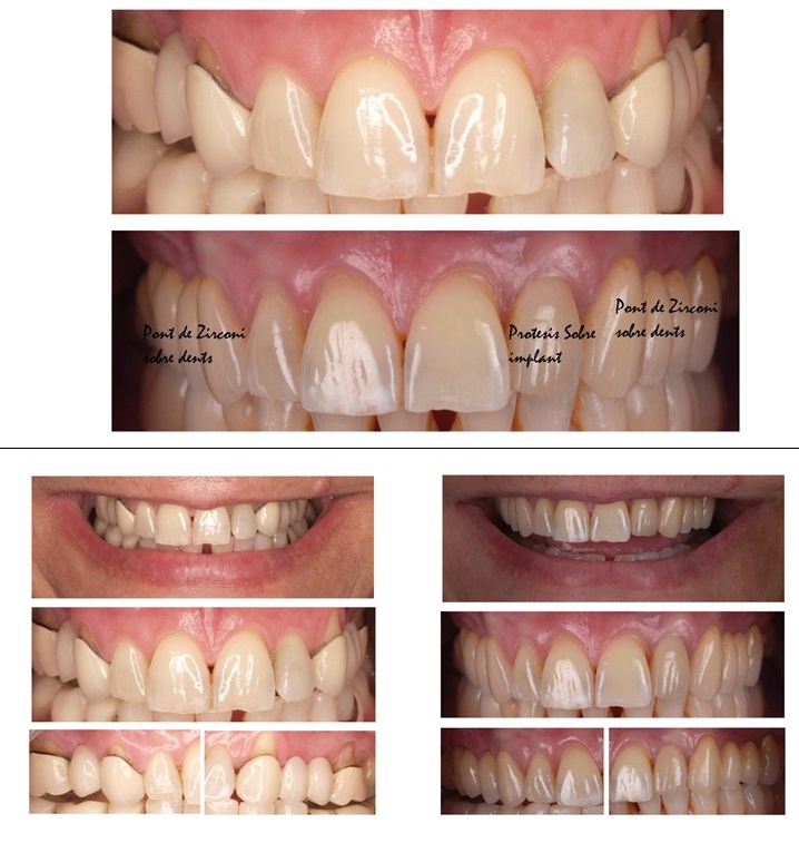 Pròtesi sobre implants