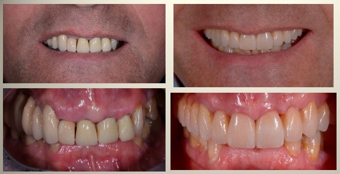 Rehabilitació amb corones sobre implants i sobre dents