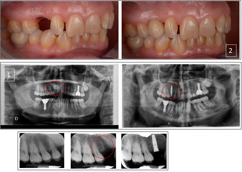 Rehabilitació amb implant i corona
