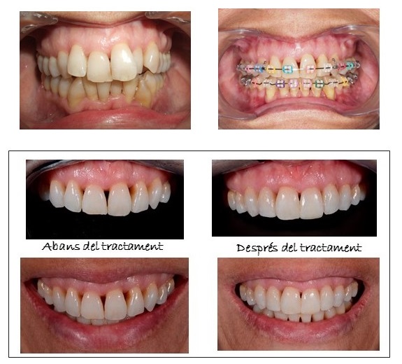 Tractament estètic amb composites