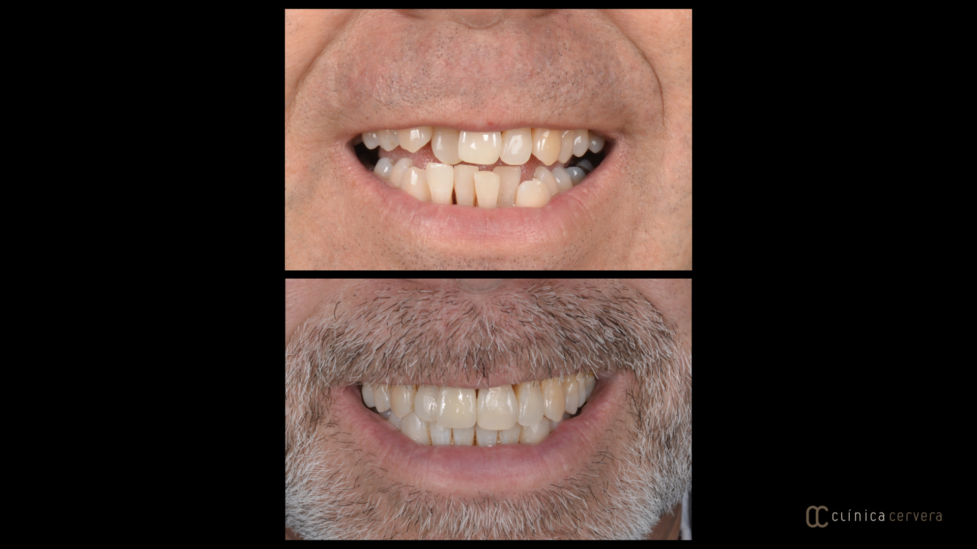 Absències dentals i maloclusió
