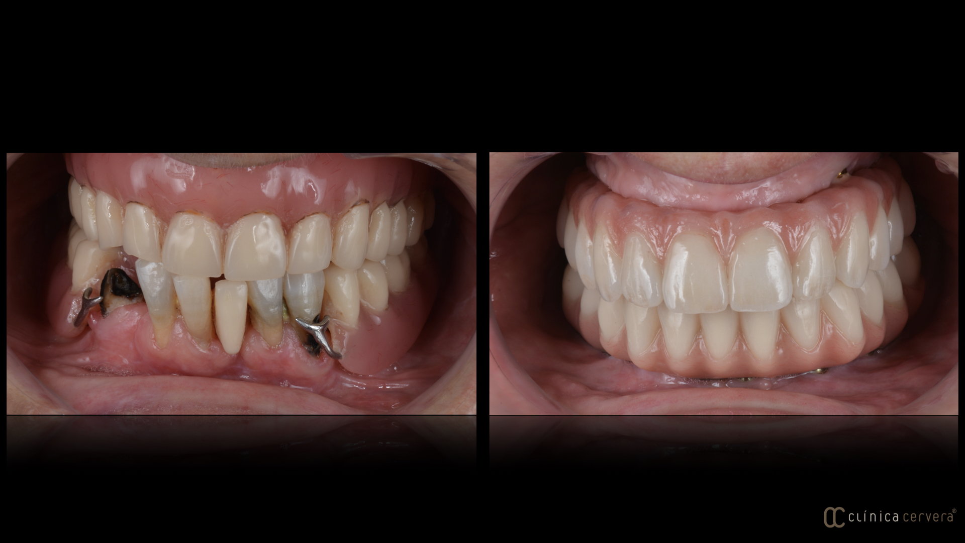 Rehabilitació Oral Completa amb Pròtesis Fixes sobre Implants