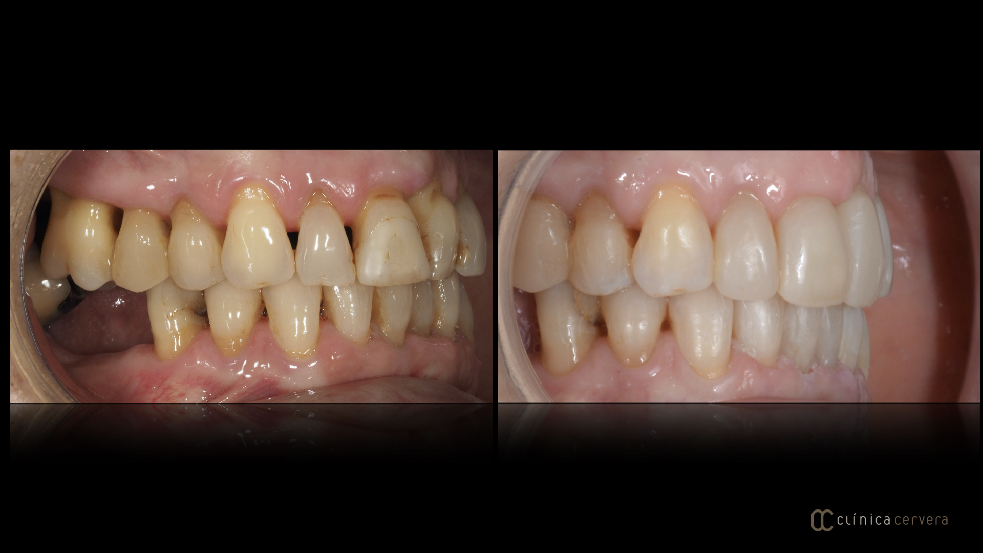 Tractament periodontal