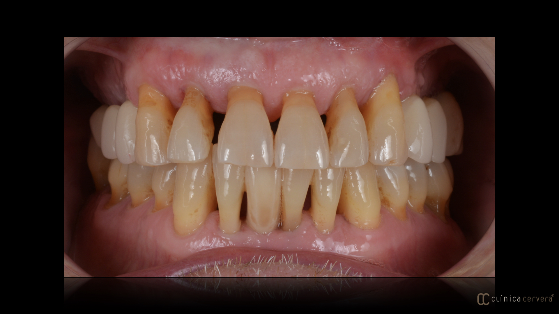 Rehabilitació sobre implants superiors
