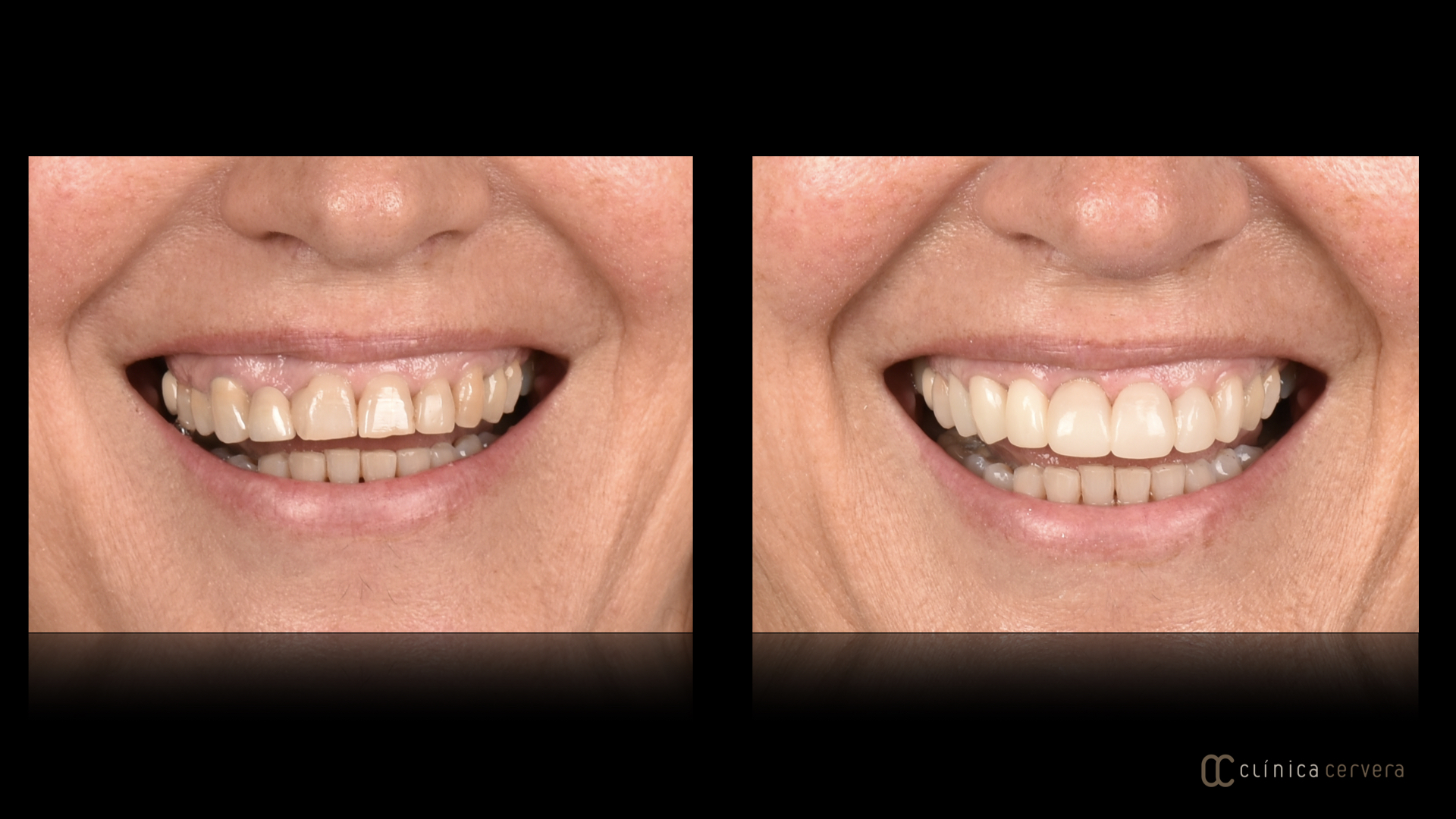 Reestabliment de les proporcions dentals