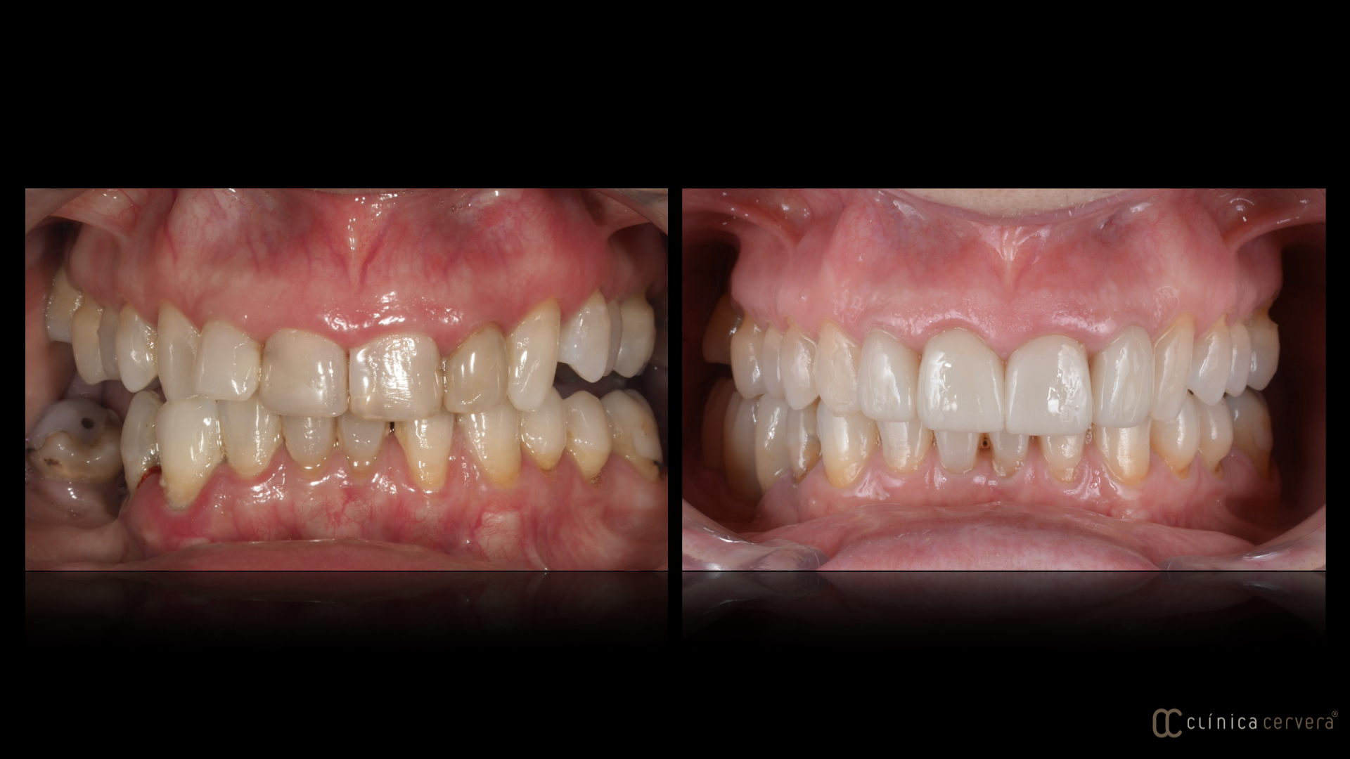 Optimització oclusal i estètica amb restauracions ceràmiques sobre dents i implants