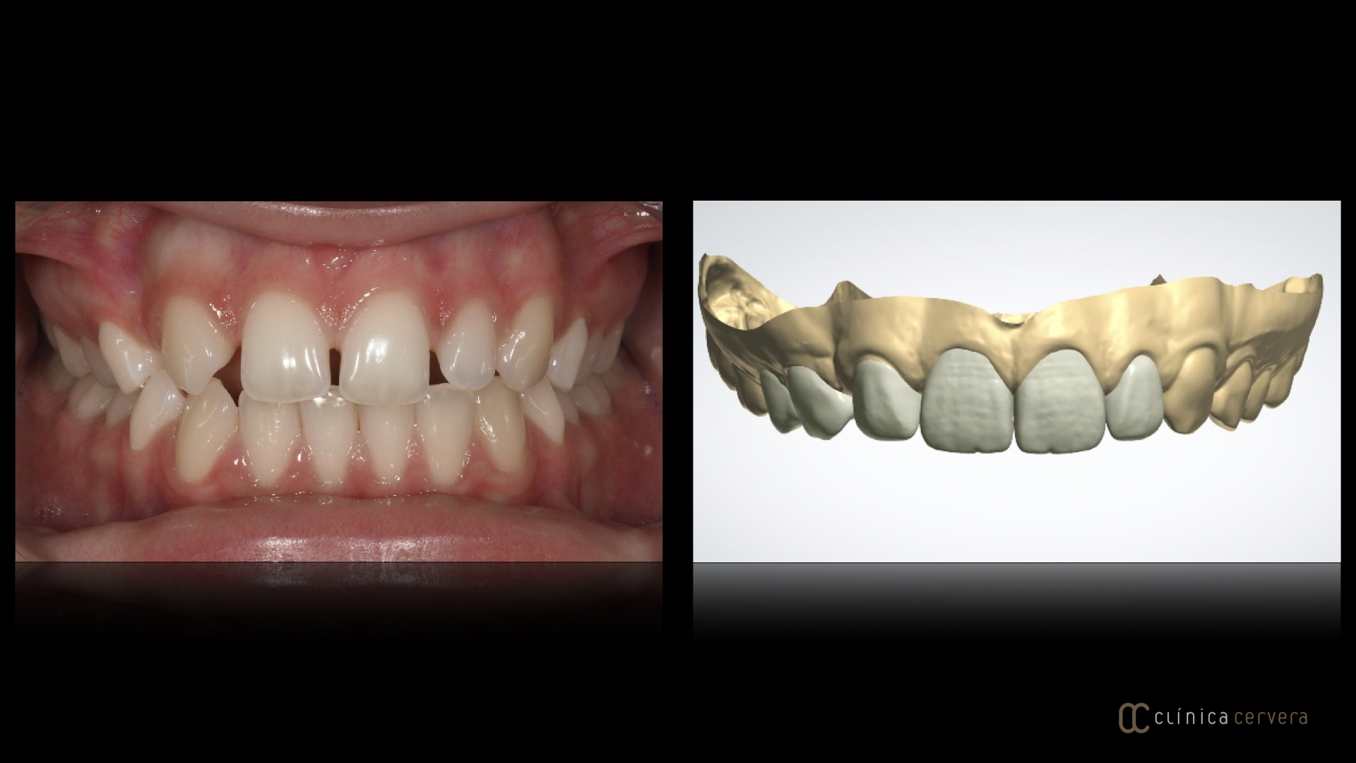 Agenèsia dental
