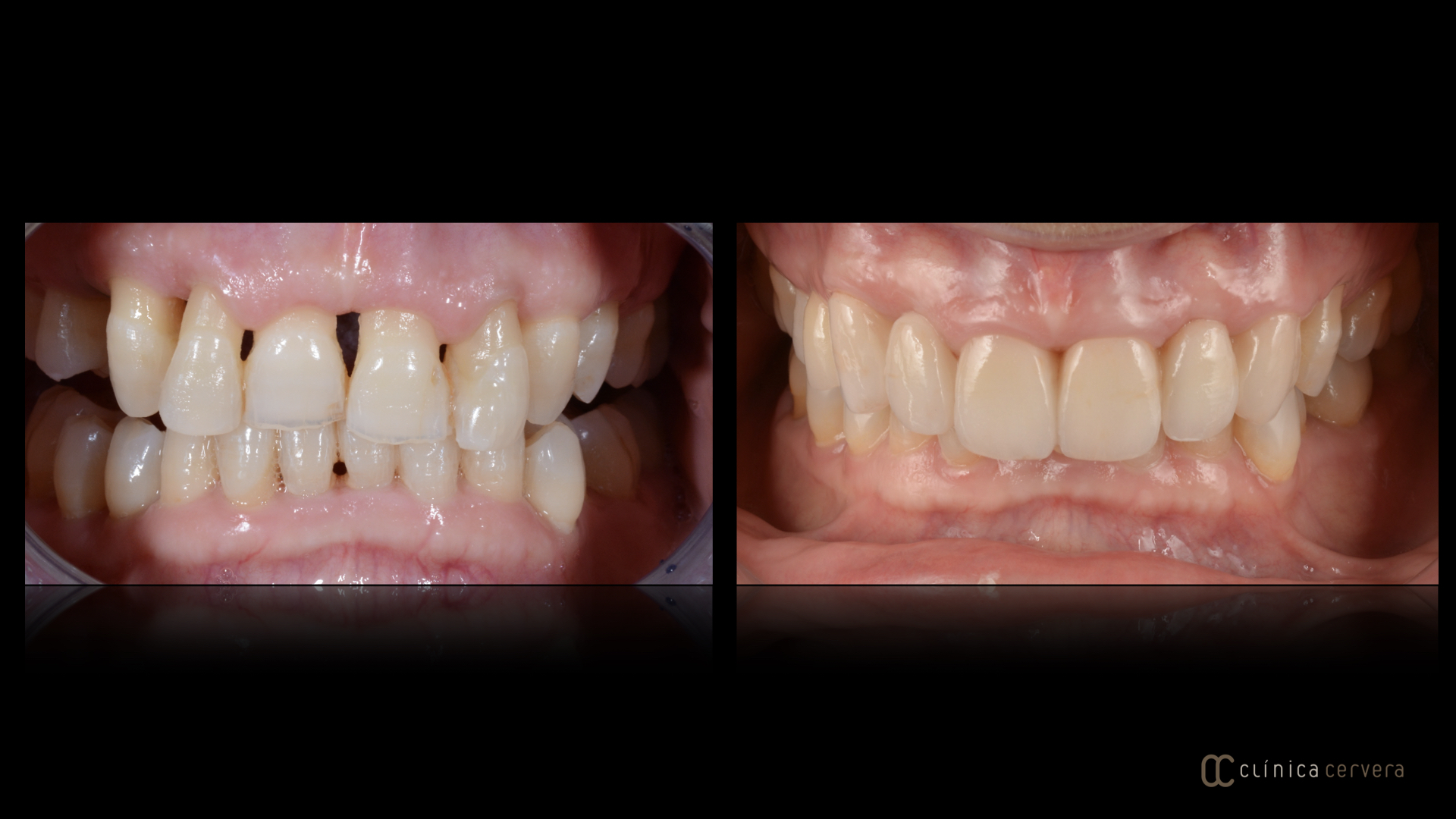 Periodontitis